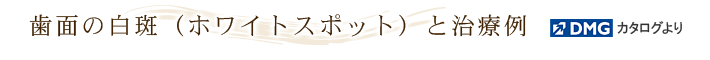 歯面の白斑（ホワイトスポット）と治療例