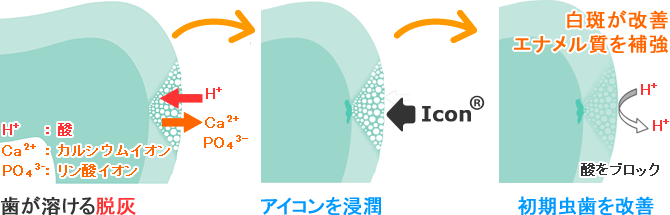 アイコンによる白斑改善・虫歯の治療