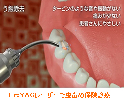 Ｅｒ：ＹＡＧレーザーで虫歯の保険診療