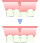 歯肉の整形