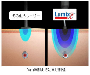 コールドレーザー（Lumix2）