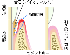 歯周ポケット掻爬術（歯周病の治療）