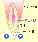 くさび状欠損（楔状欠損）