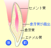 知覚過敏