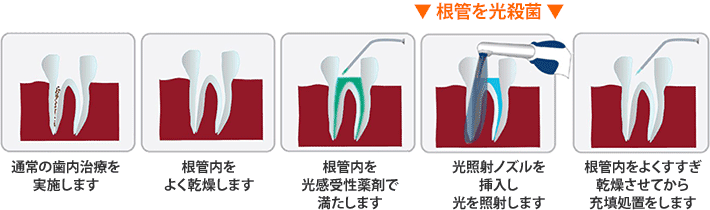 根管治療＋光殺菌治療