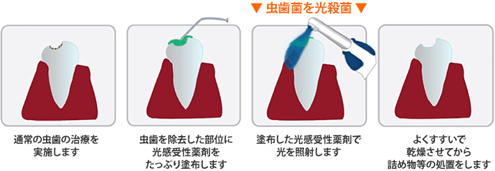 虫歯の治療＋光殺菌治療