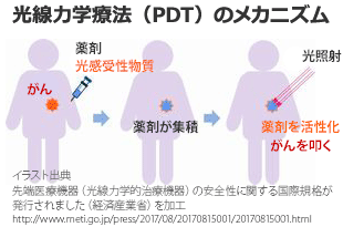 光線力学療法（PDT：Photodynamic Therapy）のメカニズム