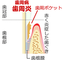 歯周病（歯肉炎の状態）