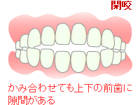 開咬