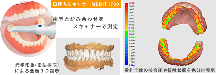 かみ合わせ測定器（口腔内スキャナー）