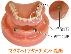 金属床義歯：コバルトクロム