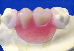 ブリッジ義歯（人工歯併用タイプ）