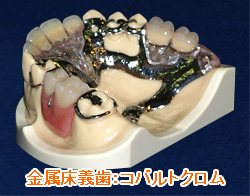 金属床義歯：コバルトクロム