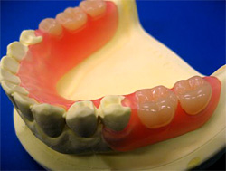 ノンクラスプ部分入れ歯