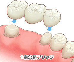 １歯欠損ブリッジの構造