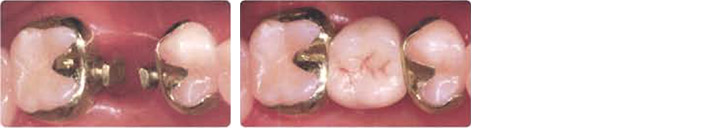 臼歯部１歯欠損のヒューマンブリッジ