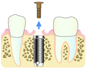 インプラントの治療手順１