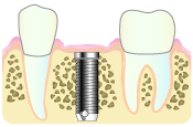 インプラントの治療手順２