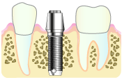 インプラントの治療手順３